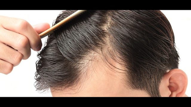 Finasteride Vs Minoxidil Which Men S Hair Loss Treatment Is Best